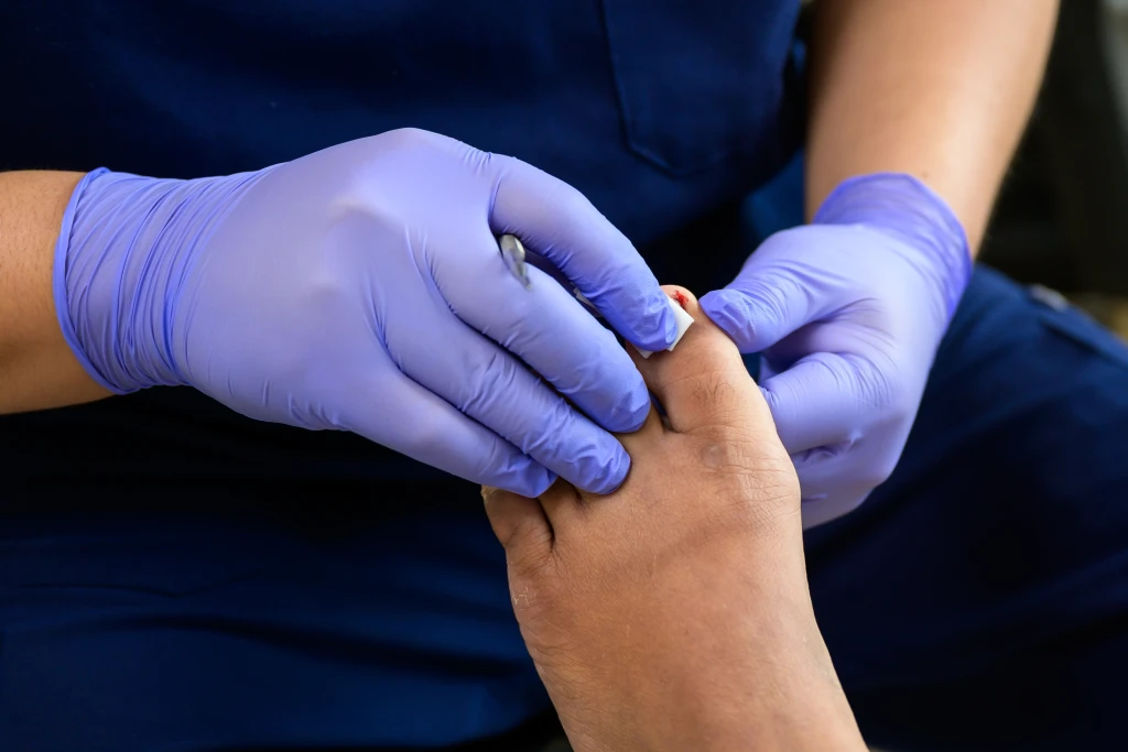 A podiatrist in purple gloves working on the corner of a patient's big toenail with a small spot of blood at the nail fold, the site where paronychia develops.