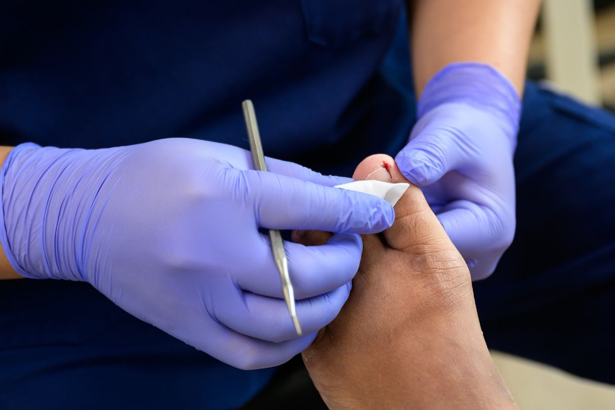 Podiatrist in Singapore providing paronychia treatment to patient.