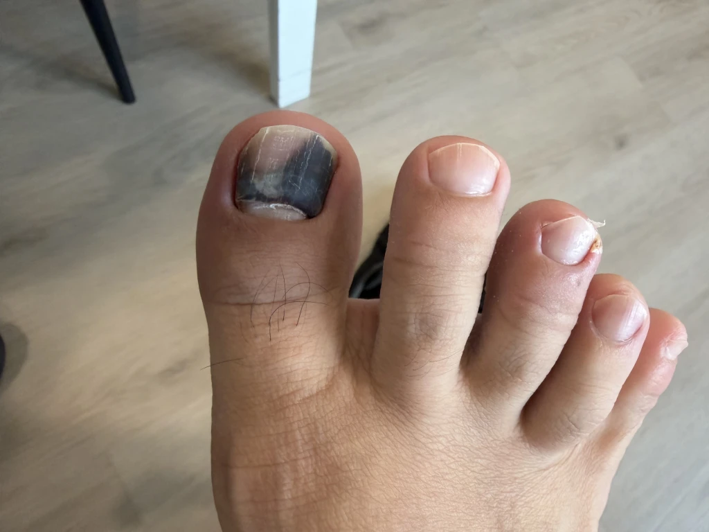 俯视角度的裸足特写，位于木地板上方，拇趾甲因甲板下方陈旧积血而呈暗灰黑色，是趾甲创伤后甲下血肿的典型外观。