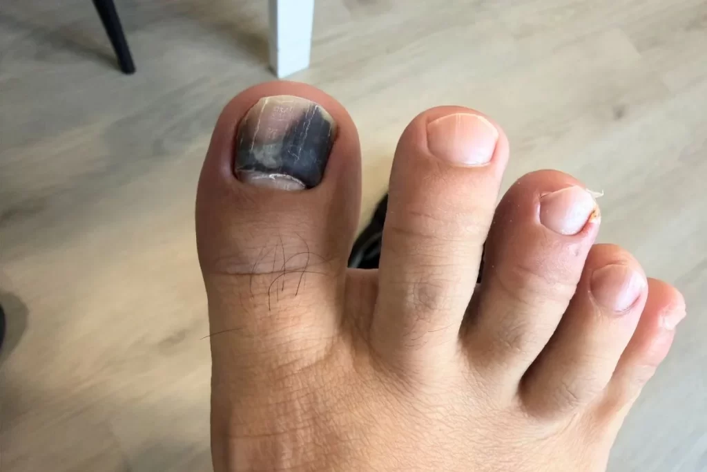 Right big toenail trauma with subungual haematoma