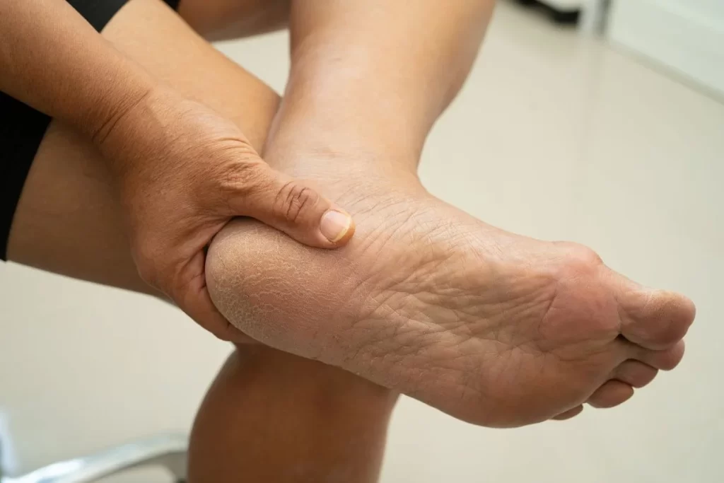 Woman with persistent heel pain when standing, caused by heel fat pad syndrome