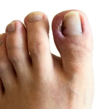 ingrown toenail treatment by podiatrist