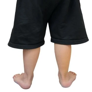 paediatric flat feet treatment by podiatrist