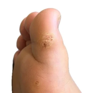Plantar wart treatment by podiatrist