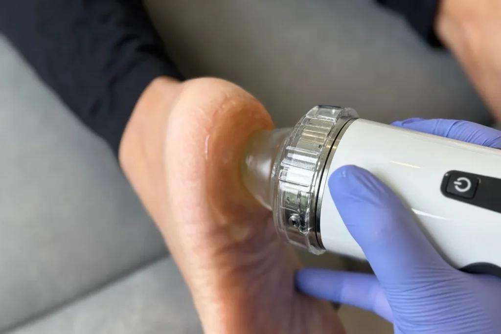 Patient receiving focused shockwave therapy for treatment of plantar fasciitis in Singapore