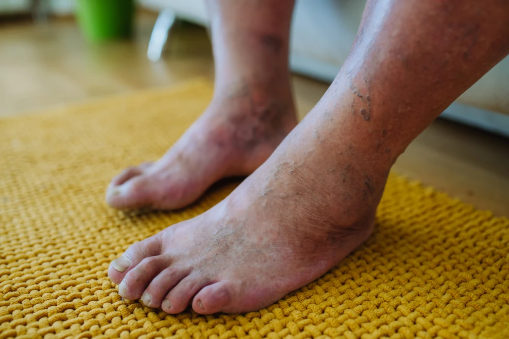 Illustration showing the affected area in Diabetic Foot