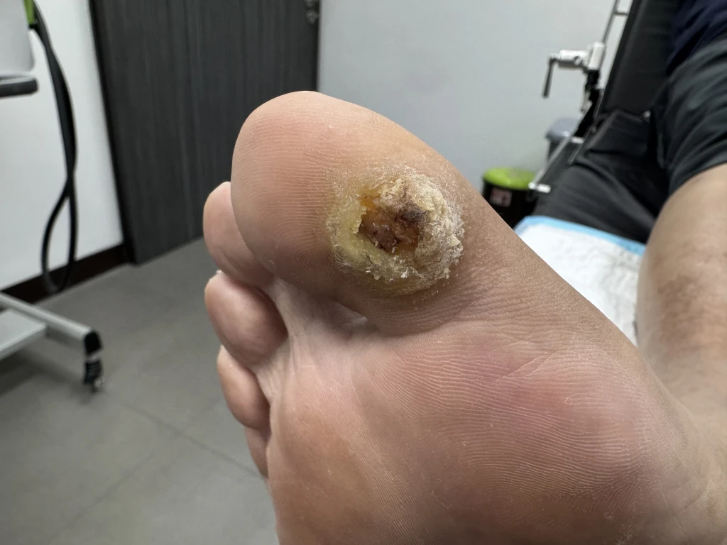 Close-up of the sole of a foot showing an open ulcer ringed by thick yellow callus below the big toe joint, a wound assessed during diabetic foot care.