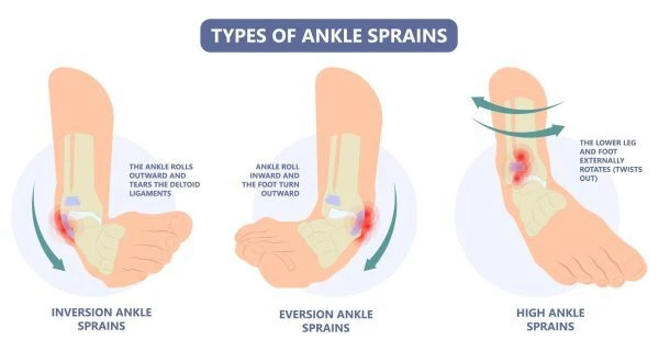 A labelled medical illustration titled Types of Ankle Sprains, comparing inversion, eversion, and high ankle sprains with arrows showing the direction of each injury mechanism.