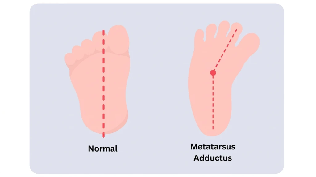 Illustration comparing a normal infant foot with a foot affected by metatarsus adductus, where the forefoot curves inward
