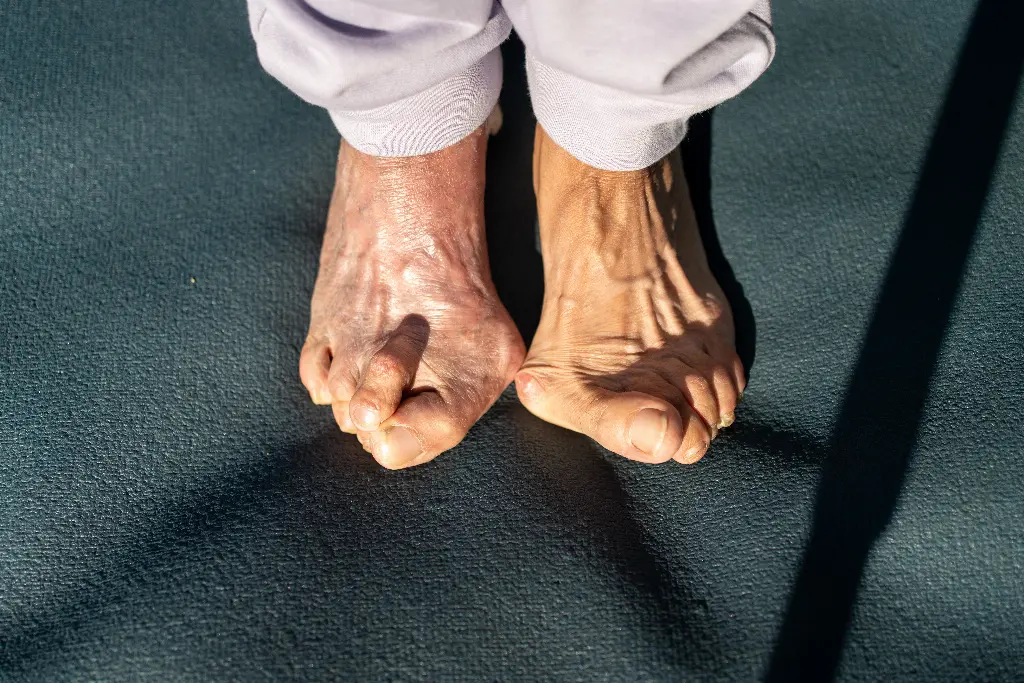 Top-down view of an older person's bare feet showing a prominent bunion and a big toe drifting across its neighbour, a joint change that often brings toe pain.