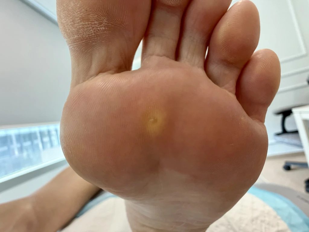 Close-up of the sole of a bare foot in a clinic room showing a hard yellow corn on the ball of the foot, the pressure lesion behind questions about how to prevent foot corns.
