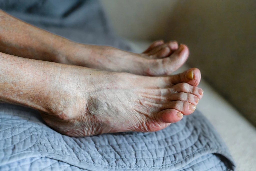 Close-up of an older person's bare feet on a quilt showing dry wrinkled skin and thickened discoloured toenails, the foot changes watched to catch diabetic gangrene risk early.
