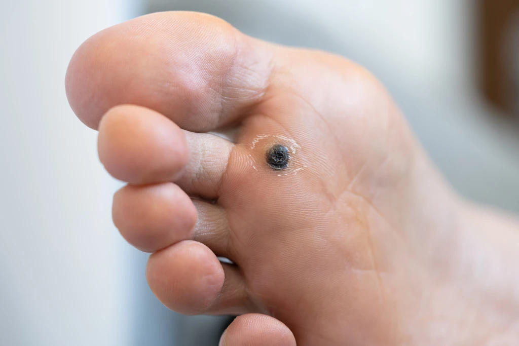 Close-up of the sole of a foot showing a small dark plantar wart on the ball of the foot