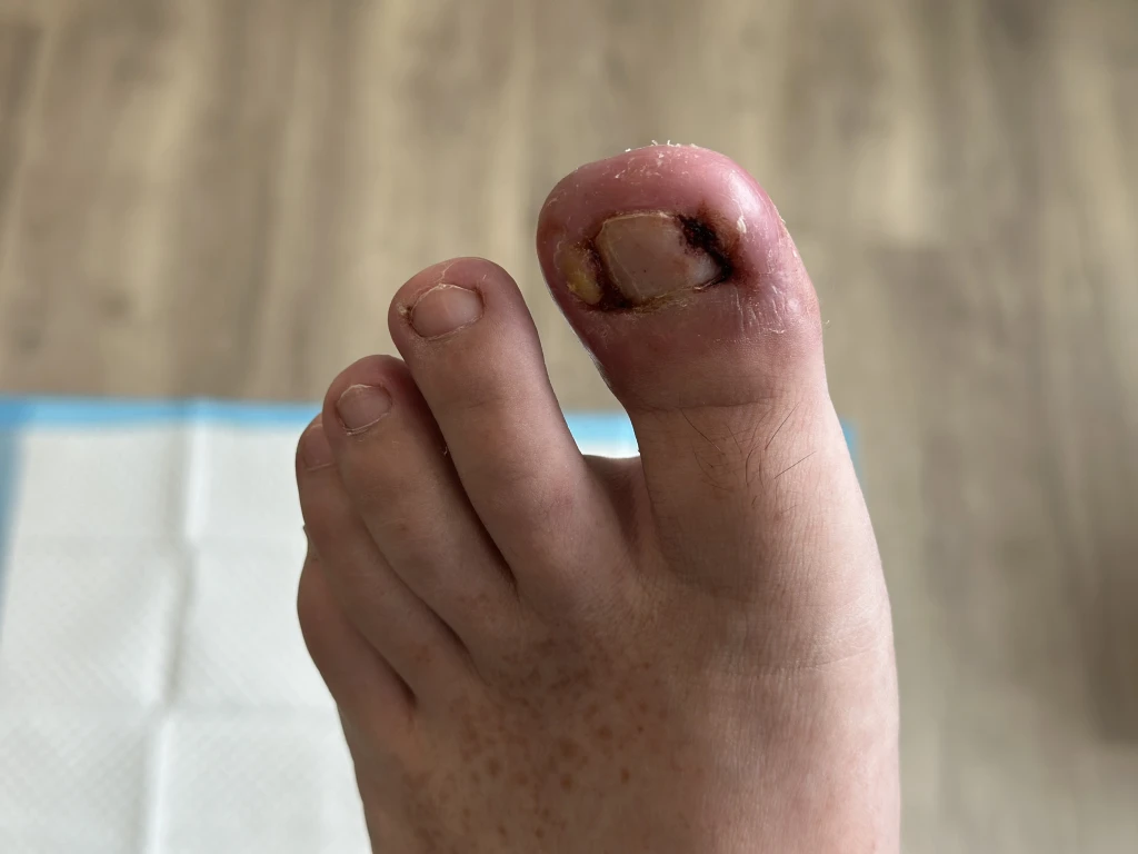 Close-up of a big toe with a red, swollen nail fold and dark crusting along the nail edge, the overlapping appearance behind paronychia vs ingrown toenail.