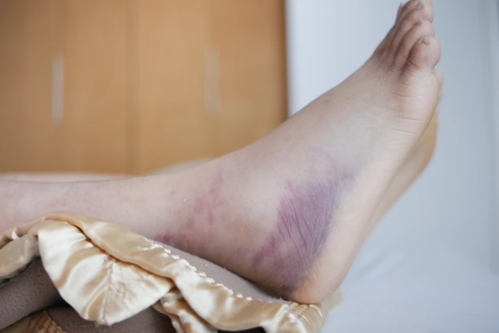 A bare lower leg and ankle resting on a bed with extensive purple bruising over the outer ankle, which can follow either a high ankle sprain or low ankle sprain