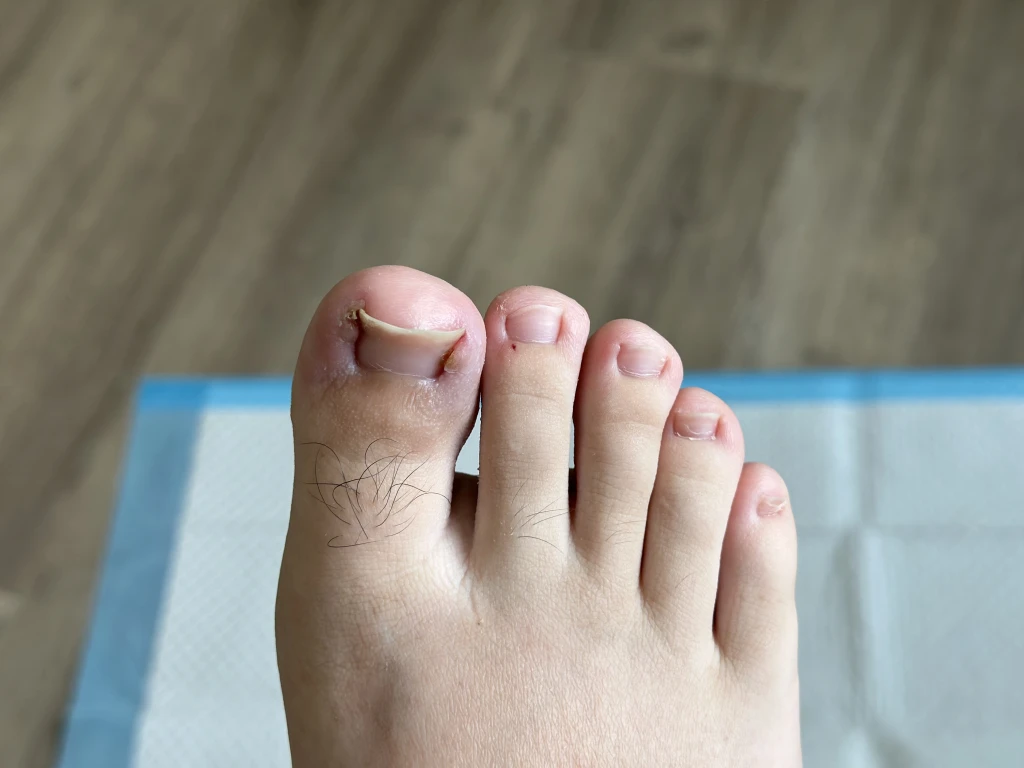 Close-up of a big toenail with a jagged nail spike lifting from the corner of the nail fold, the stage where people ask what ingrown toenail home remedies actually work