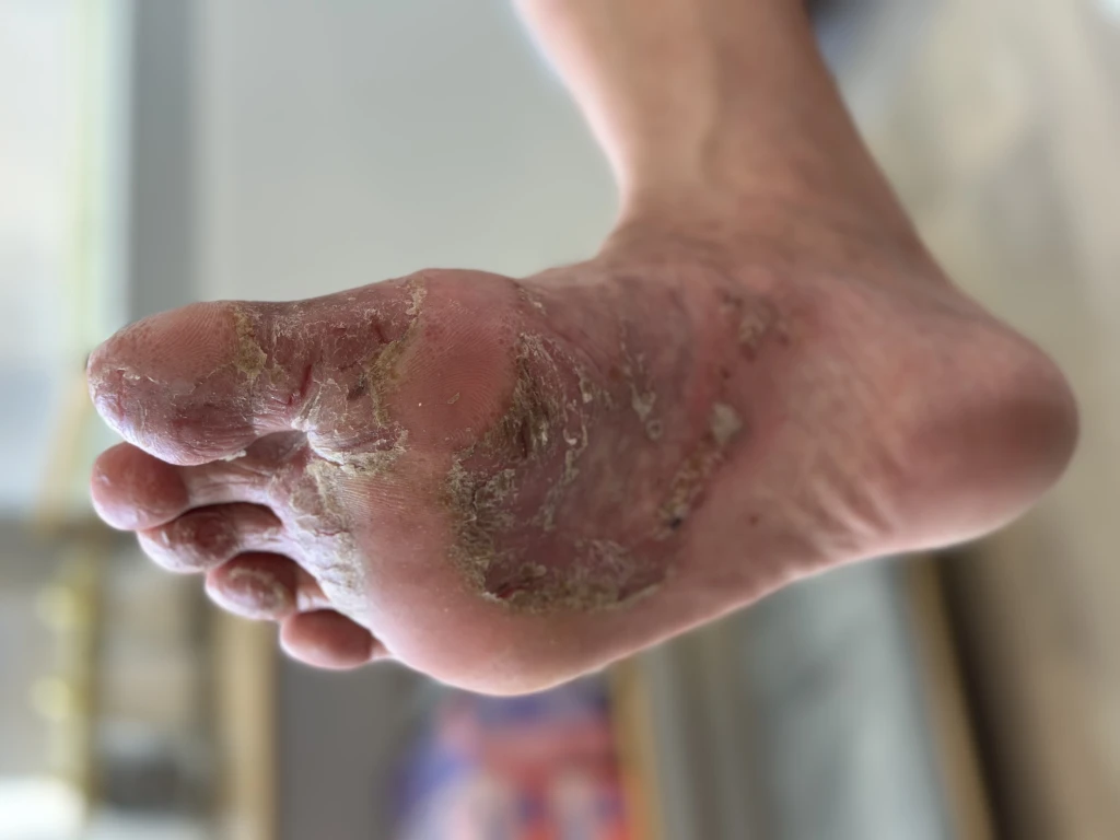 The sole of a foot covered in widespread scaling and flaking skin across the forefoot and arch, the depth of skin involvement behind why fungal infections are difficult to treat.