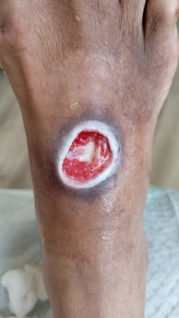 Close-up of an open circular wound with a red base and dark surrounding skin on the top of a foot near the ankle