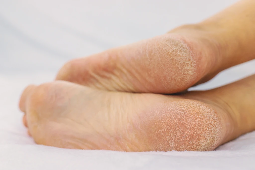 Close-up of the soles of two bare feet showing dry, flaky, cracked skin over the heels