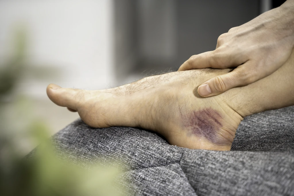 A hand resting on a bare ankle with a purple bruise below the outer ankle bone, the visible stage early in ankle injury recovery.
