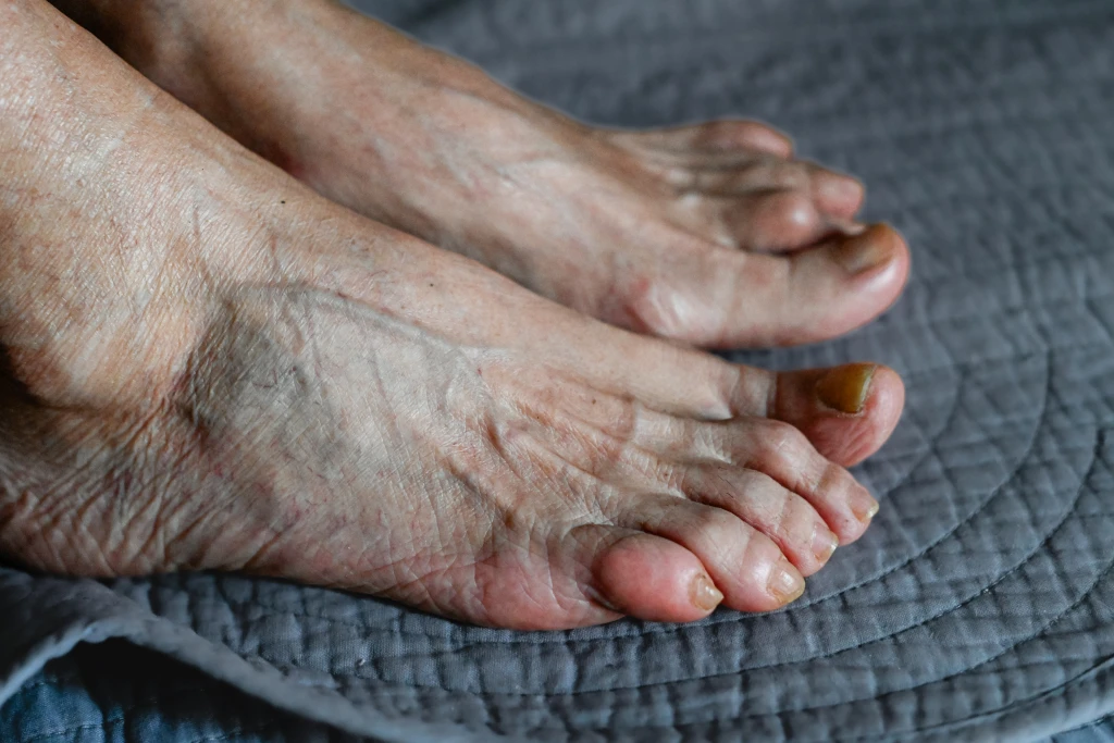 Close-up of an older person's bare feet on a grey quilt showing deviated big toes, prominent joints and thickened nails, changes weighed in osteoarthritis vs rheumatoid arthritis