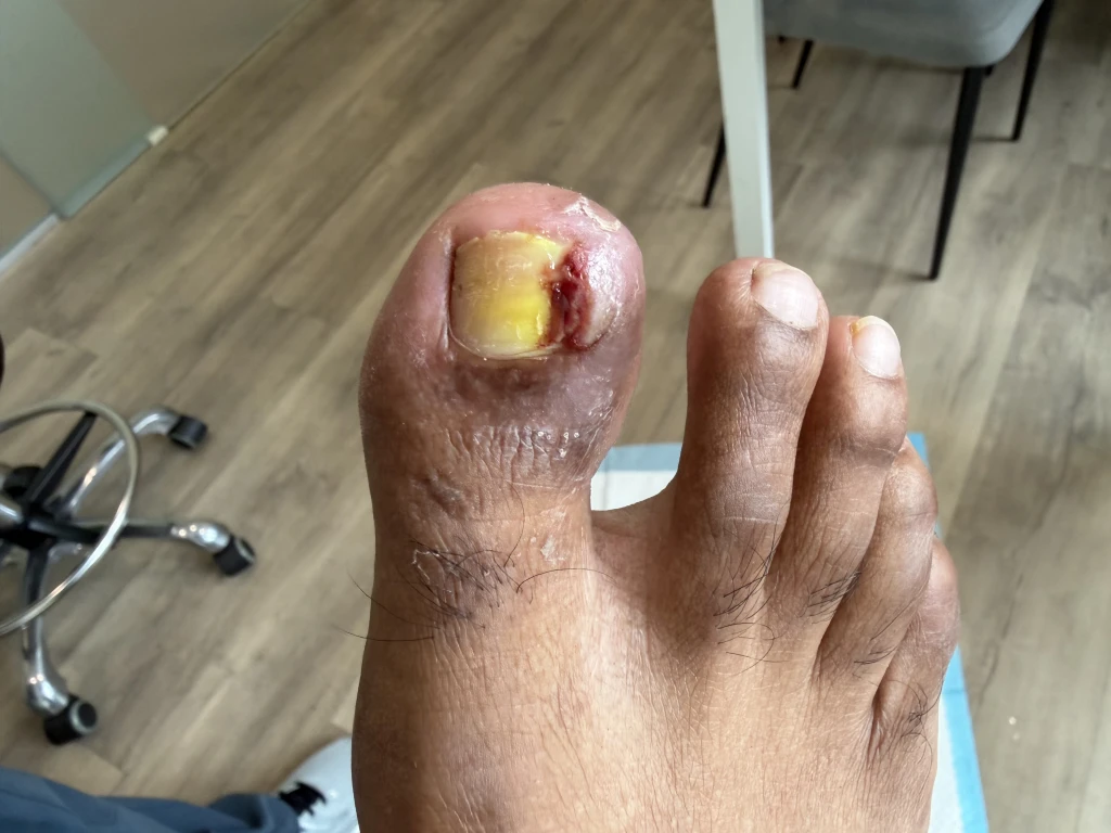 Close-up of a big toe with a swollen reddened nail fold, discoloured nail and bleeding at the nail edge, the visible signs that show how to tell if an ingrown toenail is infected.