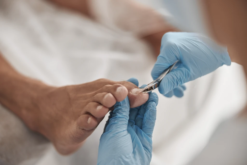 A gloved clinician trimming the big toenail of a patient's foot with nail nippers, the straight cutting technique behind how to cut toenails to prevent ingrown corners.