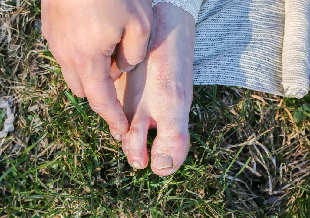 A hand holding a bare foot on grass, the second toe bent and riding over its neighbour, one of the patterns compared in hammer toe vs claw toe vs mallet toe.