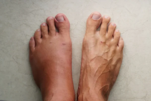 A close-up of two bare feet side by side, the left foot red and swollen around the big toe joint compared with the other foot