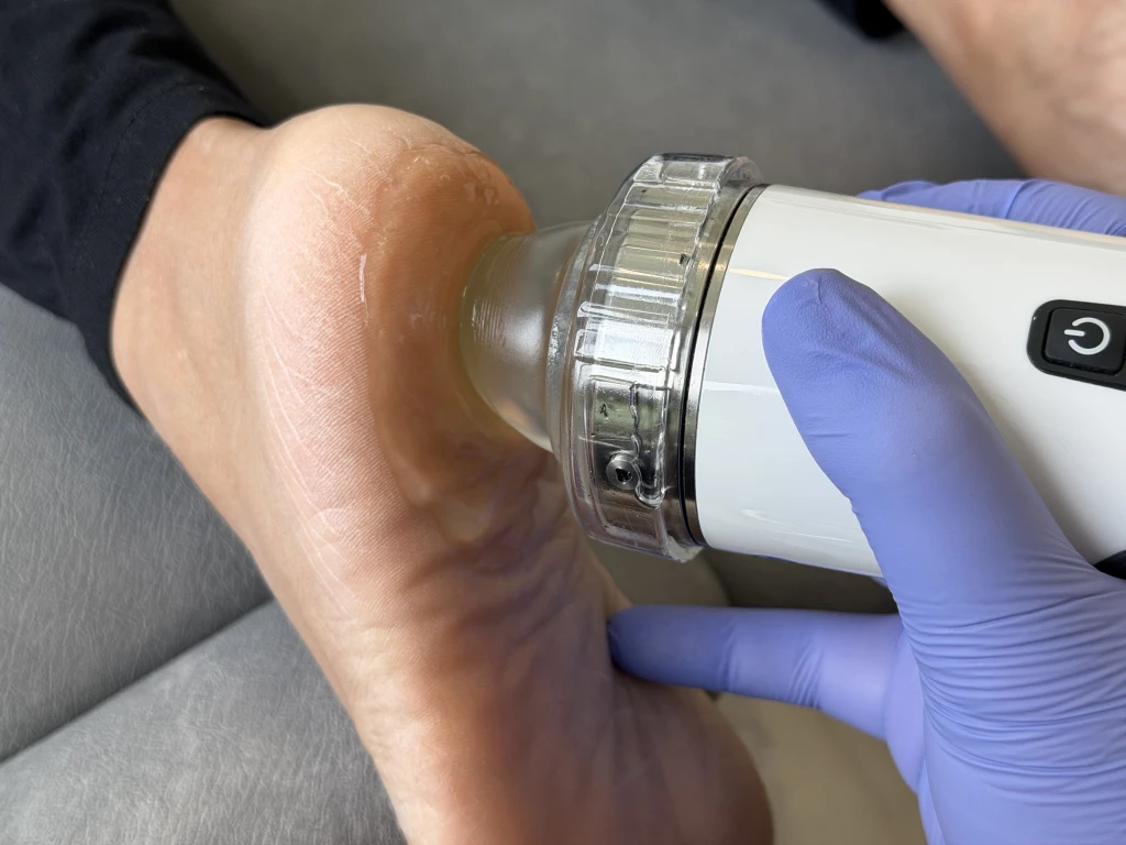 A gloved clinician pressing a gel-coated shockwave therapy applicator against a patient's heel, the non-injection option weighed in the shockwave therapy vs cortisone injection comparison.