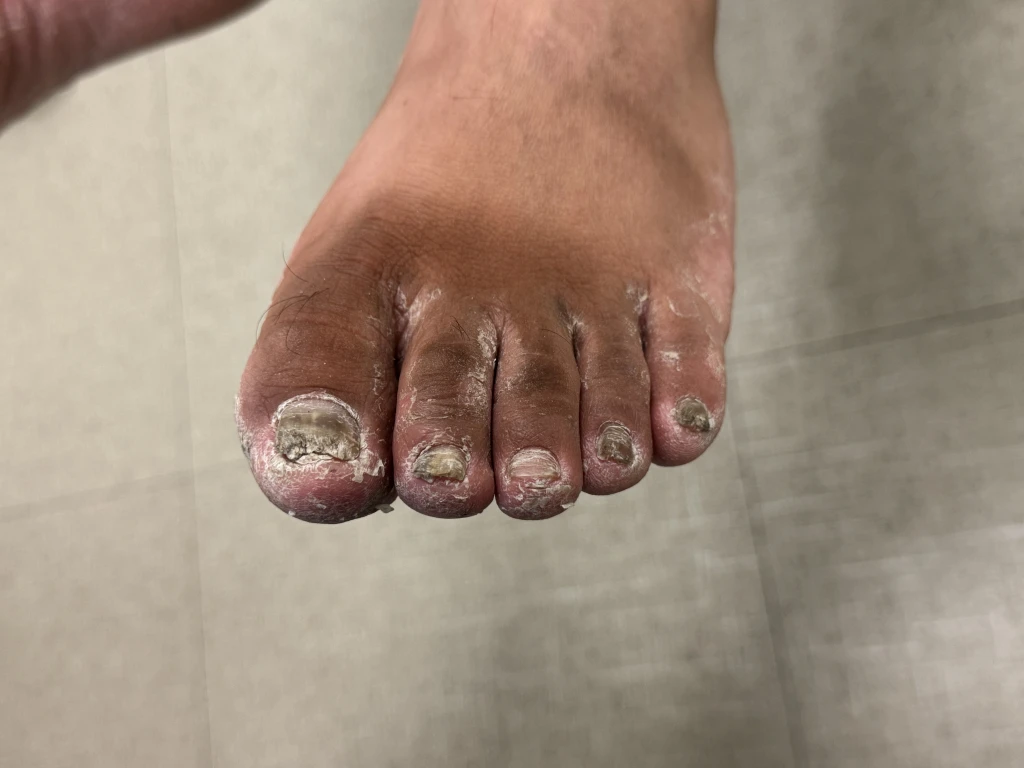 The top of a foot with thickened, crumbling, discoloured toenails and white flaking skin around the toes, showing why fungal infections are difficult to treat.