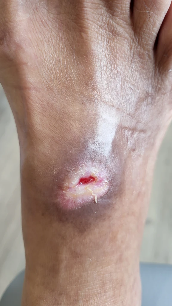 Close-up of an open wound on the top of a foot with surrounding bruising and discolouration of the skin