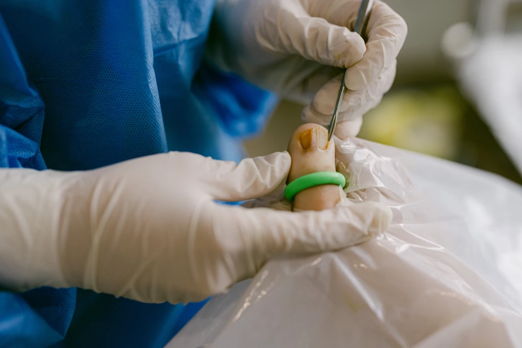Two gloved clinicians work at the nail edge of a big toe ringed with a green tourniquet, the minor procedure used once paronychia vs ingrown toenail has been told apart.