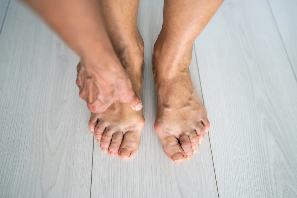 Top-down view of bare feet on a pale wood floor with both big toes deviating and joints standing out, the joint changes compared in osteoarthritis vs rheumatoid arthritis