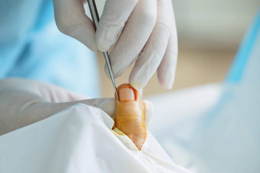 A gloved clinician uses a fine instrument to lift the edge of an antiseptic-prepped toenail under drapes, the in-clinic procedure that follows once an ingrown toenail is infected.