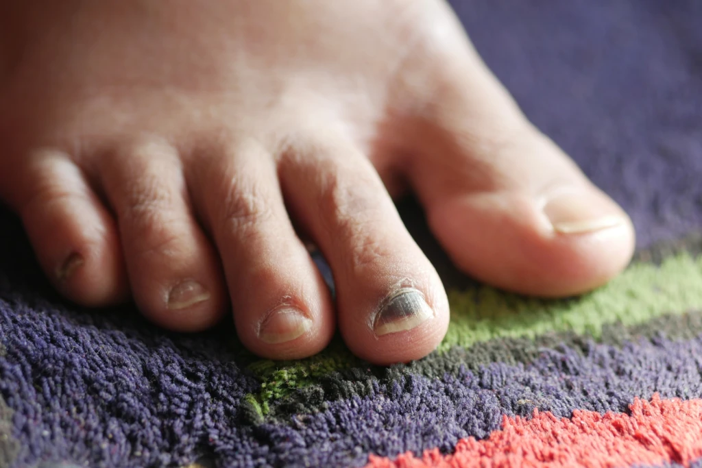 Man with a black toenail of the right second toe from direct trauma