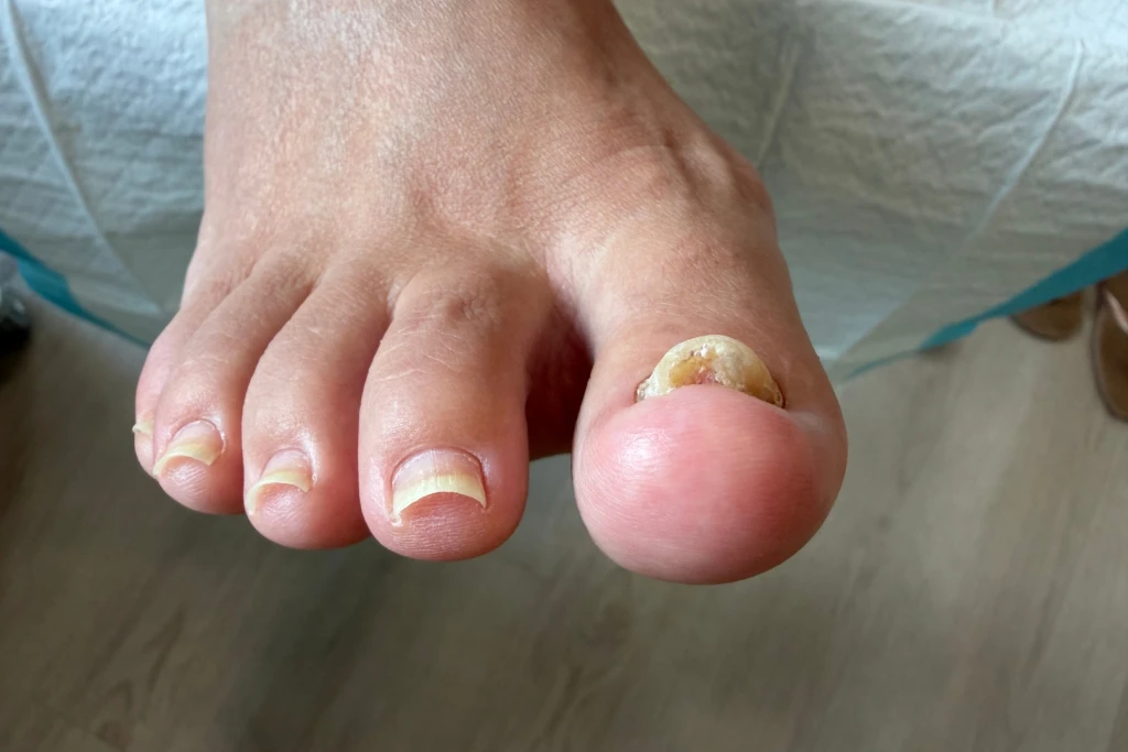 Right big toenail lifting off the nail bed due to fungal infection
