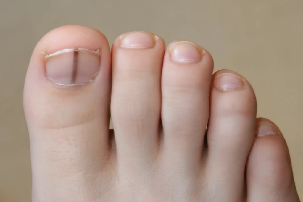 Right big toe nail with a black line extending down the middle of the nail plate.