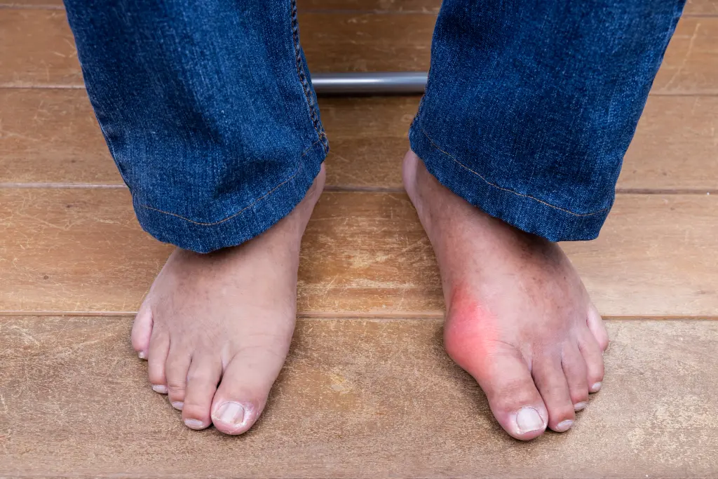 Bare feet in rolled-up jeans on a wooden floor, one big toe joint red and swollen, the appearance assessed when telling bunion vs gout apart