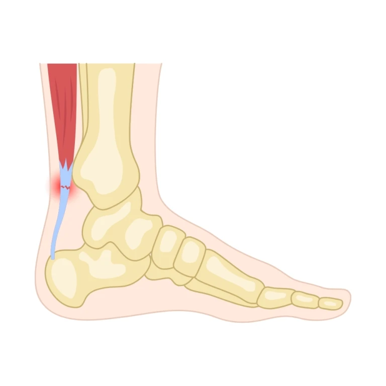 Achilles tendonitis