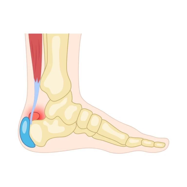Heel bursitis