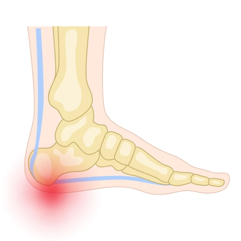 Heel fat pad syndrome