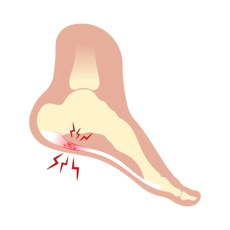 Plantar fasciitis