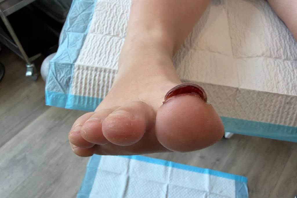 Right big toenail lifted and detached from the the nail bed after trauma.