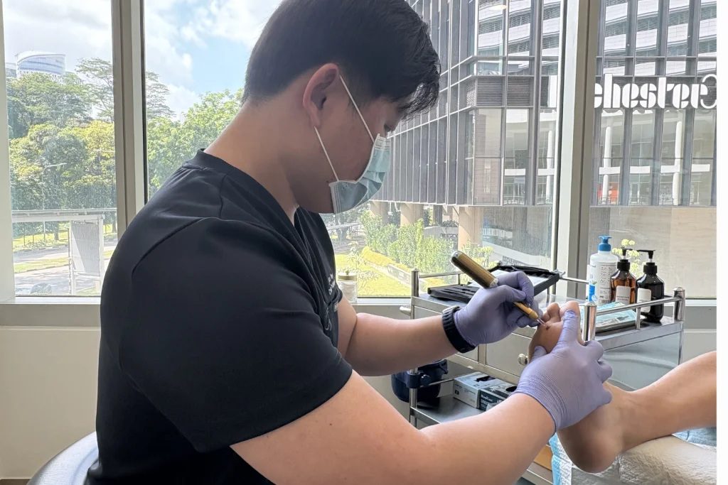 一名戴着口罩与紫色手套的足科医师,一手稳住患者的足部,一手将金色冷冻治疗笔抵在脚趾的疣状病灶上,诊所治疗室光线明亮。