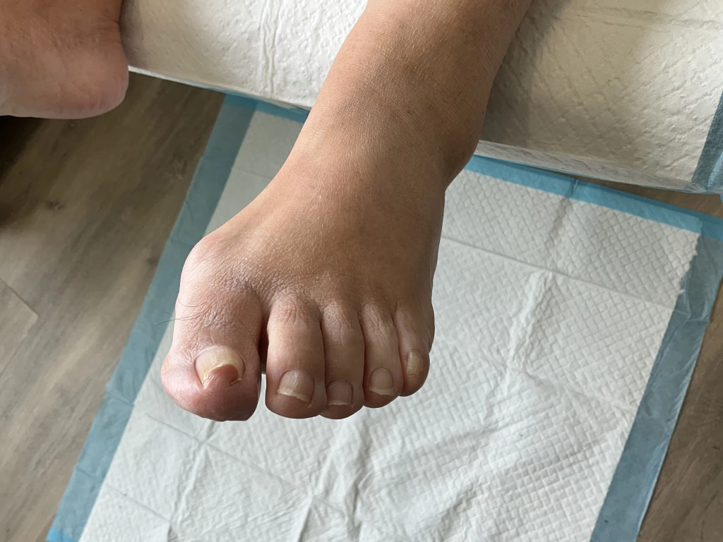 An involuted left big toenail from a middle-aged woman causing difficulty in self-management