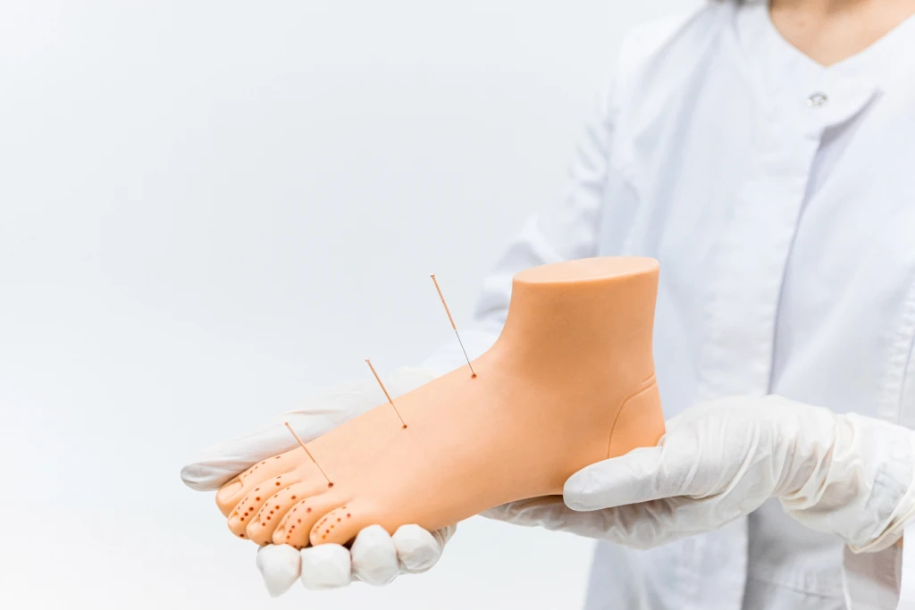 Acupuncture needles placed in a foot demonstration model held by a gloved practitioner, illustrating TCM for foot pain