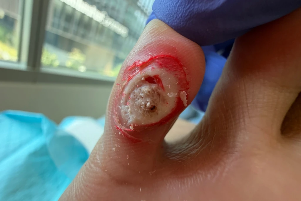 A toe with a circular acid burn from a corn plaster, a red raw ring around white macerated skin with an open crater in the centre, held by a gloved clinician