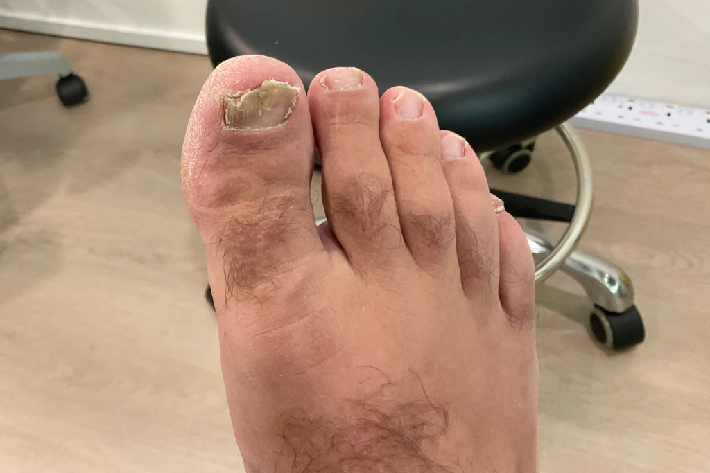 A thickened, yellow-brown big toenail crumbling at the tip with the nail lifting and dry, flaky skin around it, the kind of nail that can develop a cheese-like smell from infection