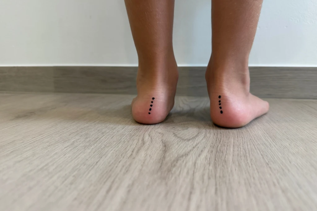 Rear view of both bare feet standing, heels marked to show the inward roll of overpronation, assessed at Straits Podiatry Singapore